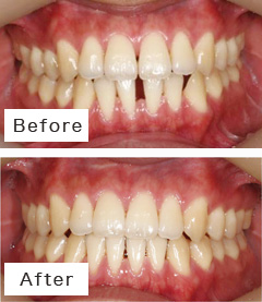 空隙歯列の治療例